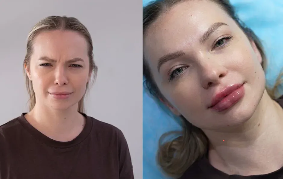 Before and after Botox treatment for forehead wrinkles and frown lines at Tinkermoon Clinic Dubai, showing smooth skin and lip filler results.