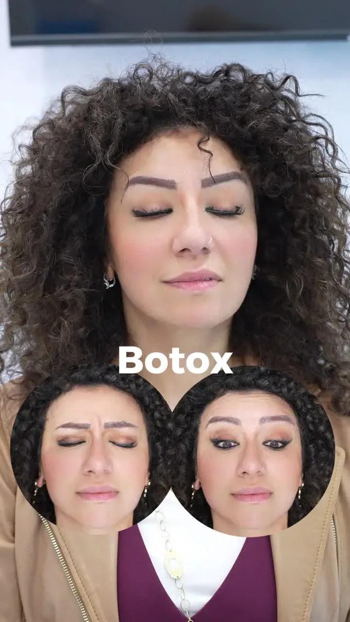 How Botox relaxes facial muscles for natural wrinkle treatment in Dubai