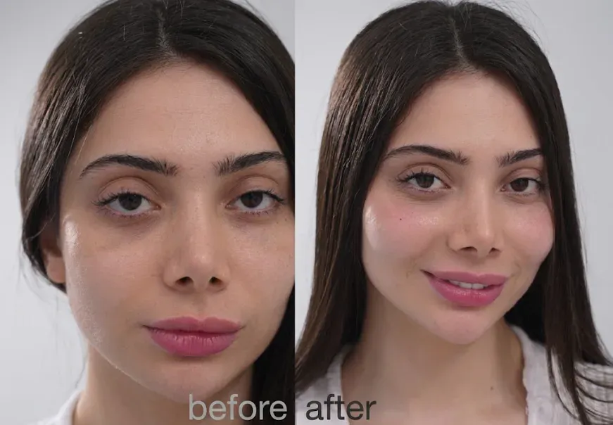 Dermal fillers before and after results at Tinkermoon Clinic Dubai