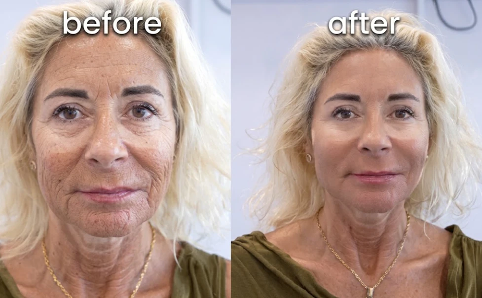 Face lift before and after comparison showing lifted jawline and smoother skin at Tinkermoon Clinic Dubai