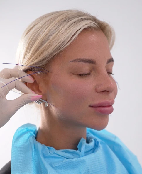 Thread lift facial rejuvenation procedure at Tinkermoon Clinic Dubai