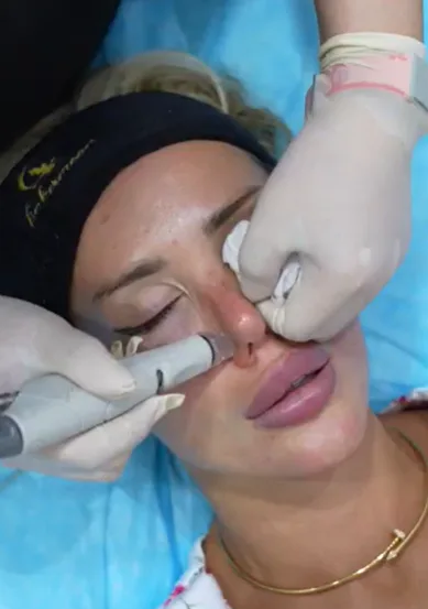 HydraFacial device cleansing and extraction at Tinkermoon Clinic Dubai