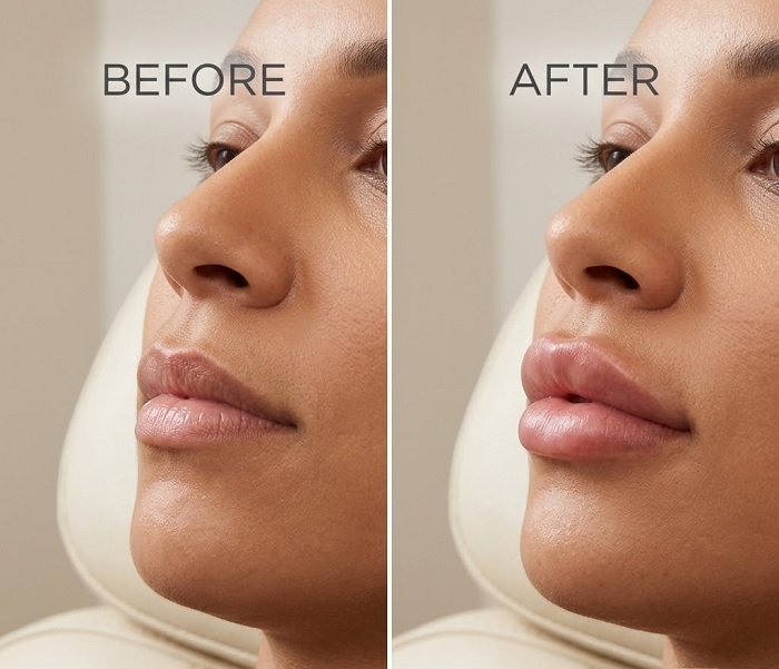 Lip Filler Vermilion Border Definition and Hydration in Dubai