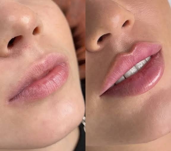 Lip Augmentation Results - Natural Lip Volume and Shape in Dubai