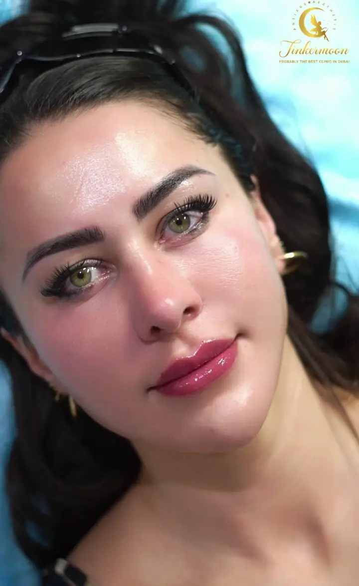Lip Fillers in Dubai