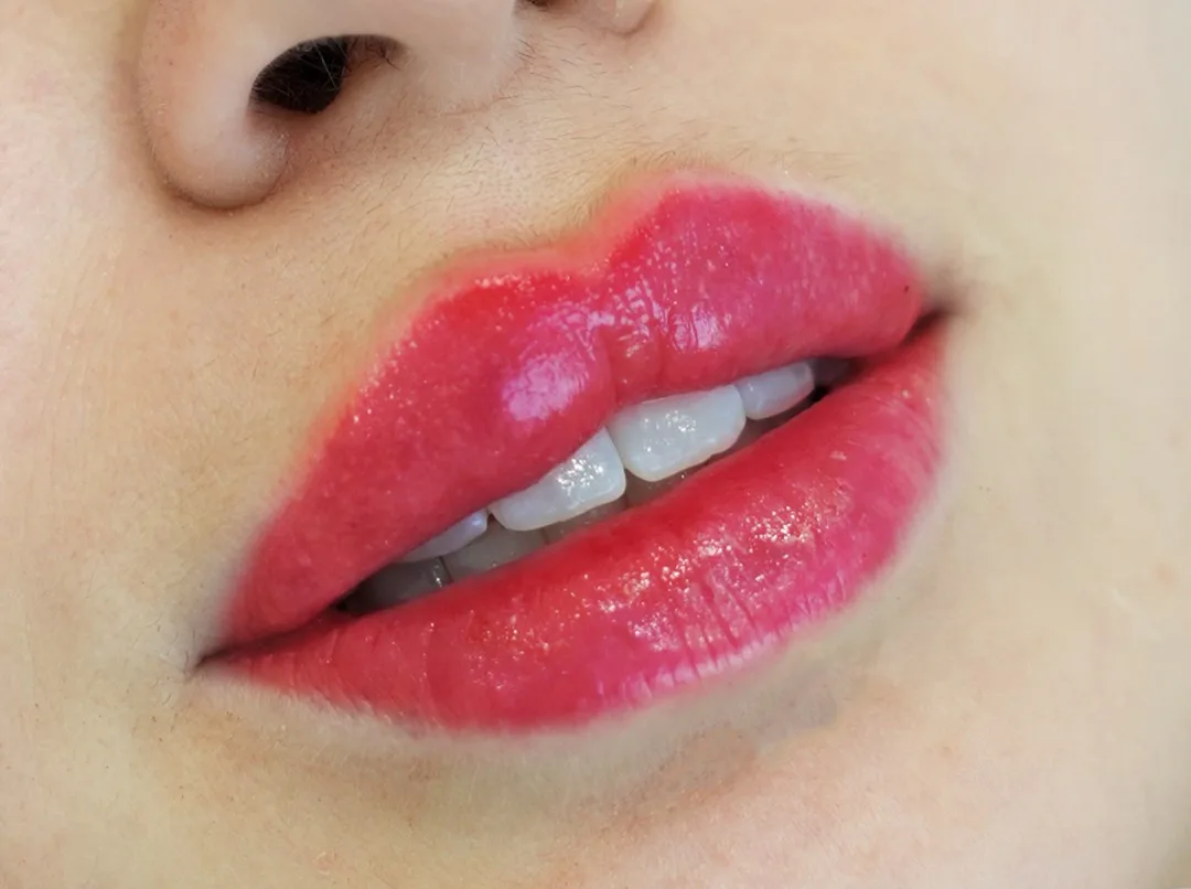 Close-up of plump glossy pink lips illustrating important patient guidelines for lip fillers in Dubai