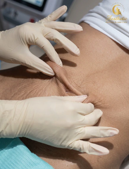 Contoured waistline result illustrating liposuction body sculpting benefits at Tinkermoon Clinic Dubai