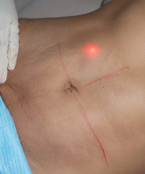 Clinical assessment of abdominal fat and skin for liposuction candidacy at Tinkermoon Clinic Dubai