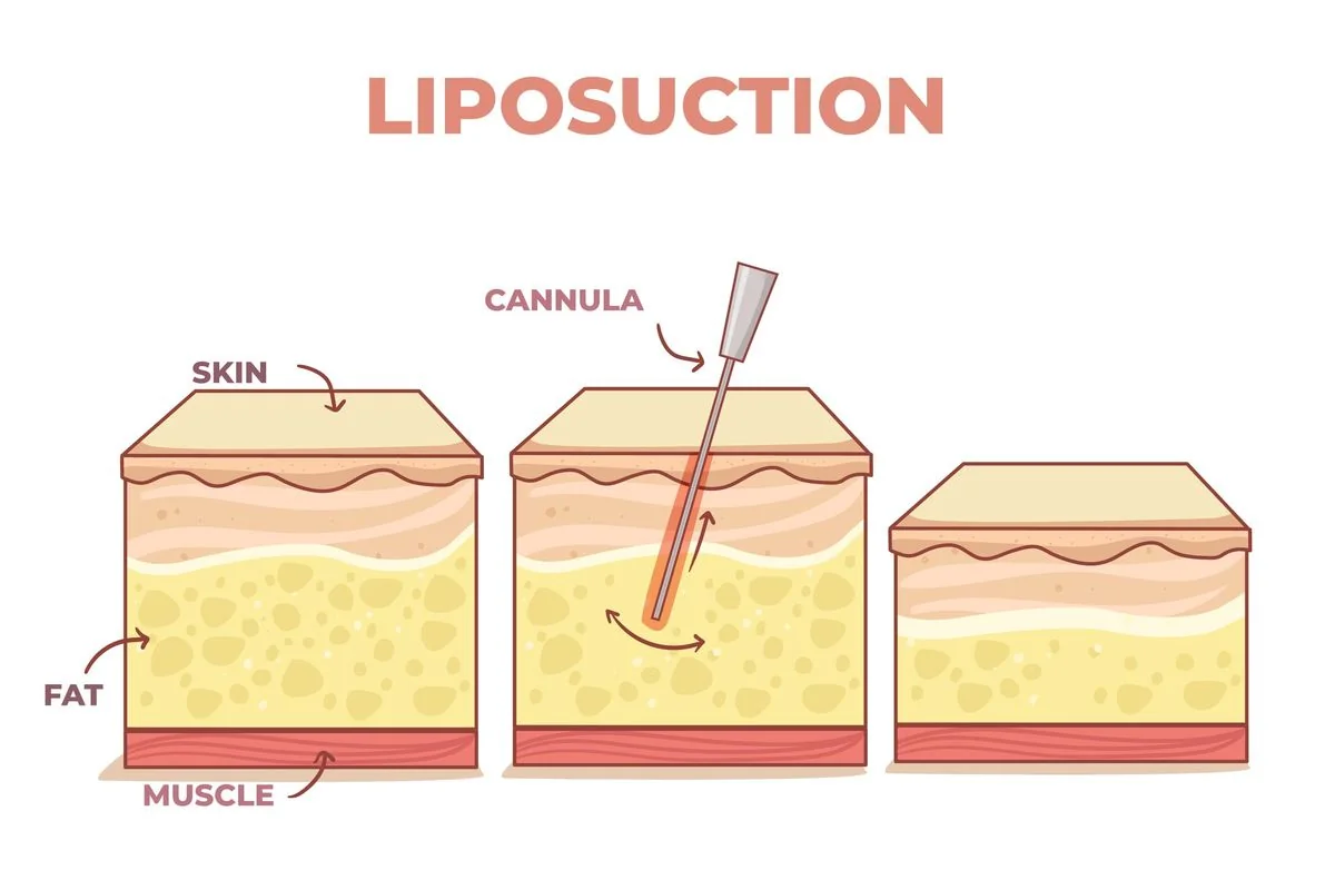 Maintain Results After Liposuction