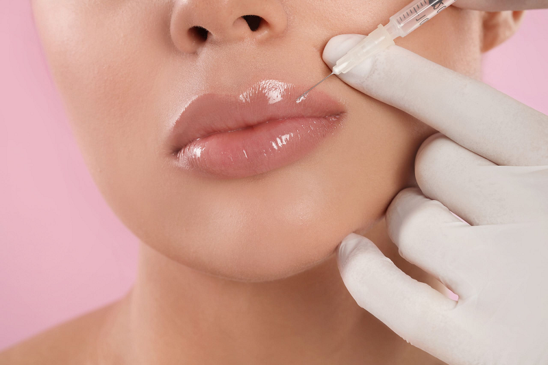 Hyaluronic Acid Lip Filler Procedure - Tinkermoon Clinic Dubai