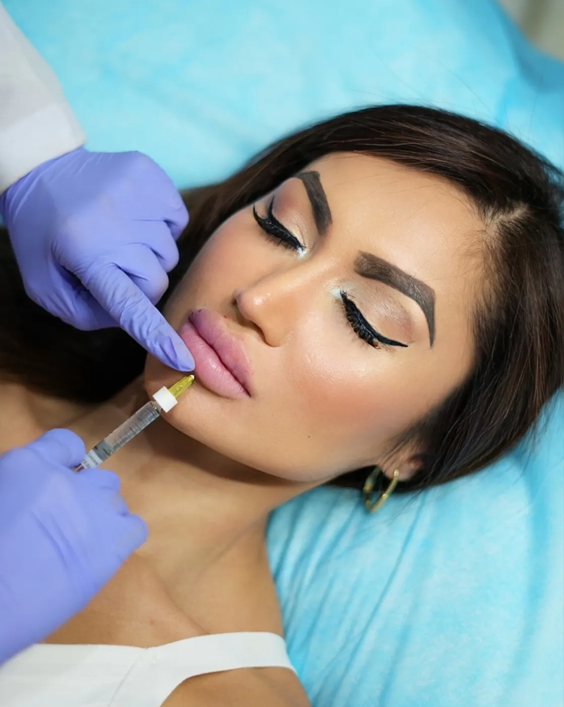 Why Lip Fillers Are Popular in Dubai - Aesthetic Trends and Natural Enhancement