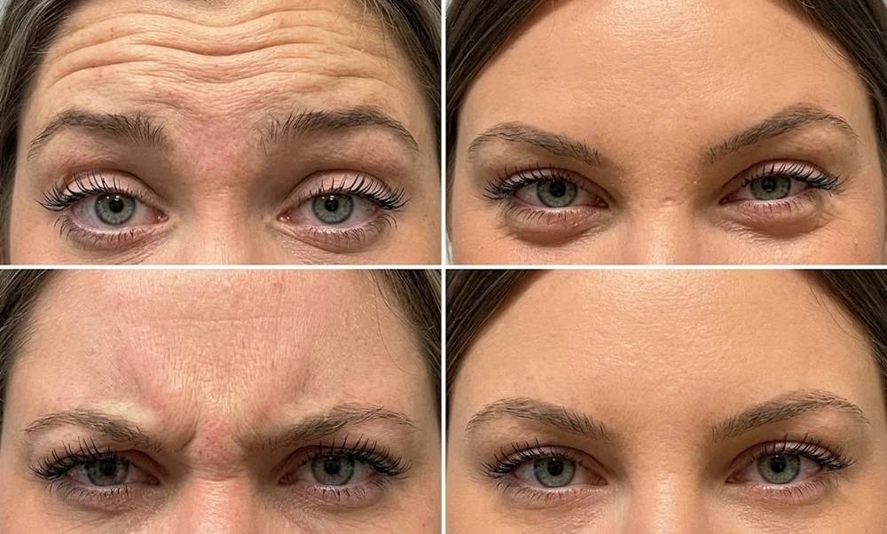 Make Botox Results Last Longer