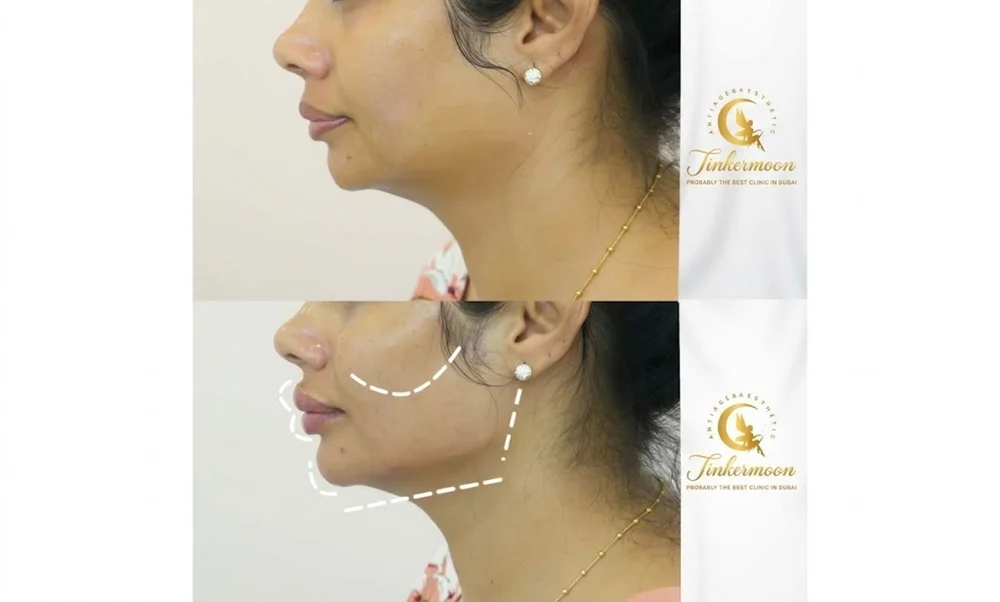 dermal fillers  Enhance lip volume and definition