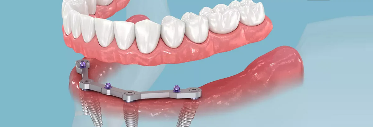 Implants