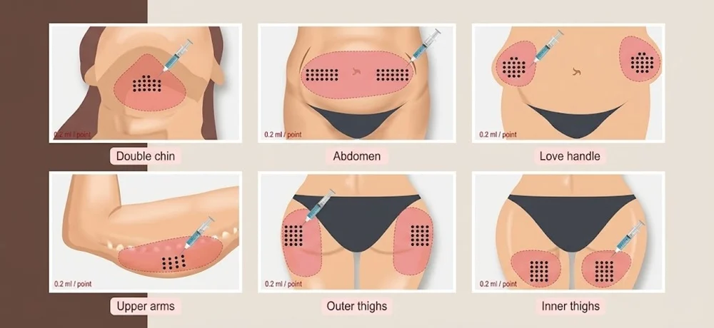 Fat-dissolving injections are designed to target small, localized fat deposits