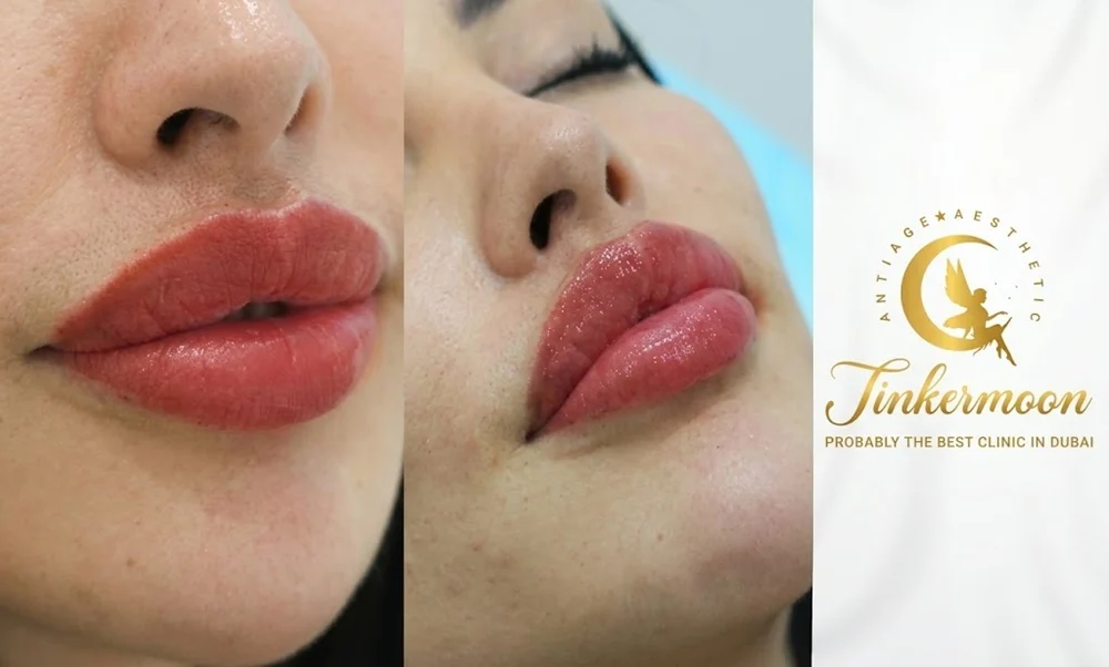 how long do dermal fillers last