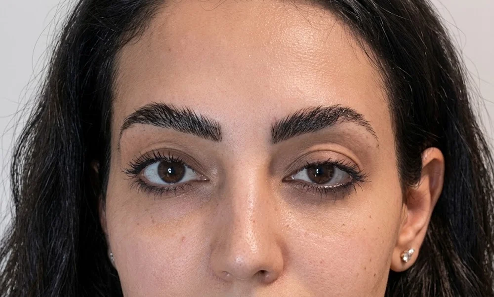 Common Botox Side Effects