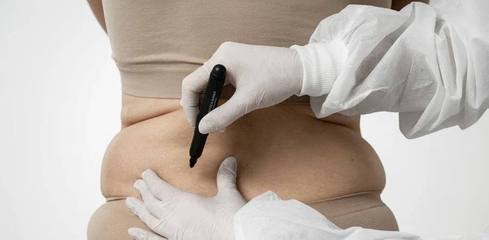 Non-Surgical Fat Reduction Treatments