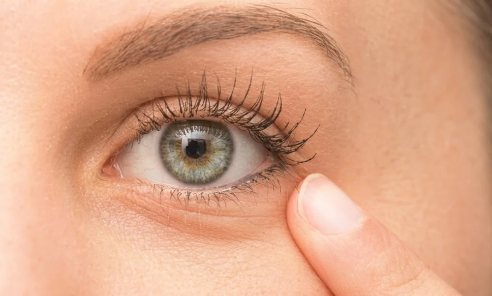 Under Eyes (Tear Trough)