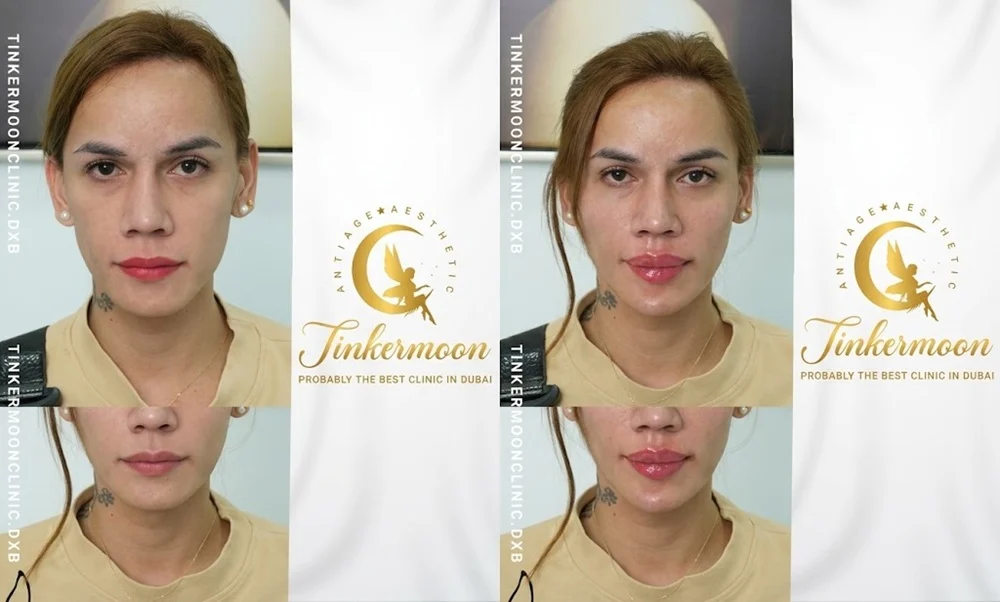The lips are one of the most popular areas for filler treatmen