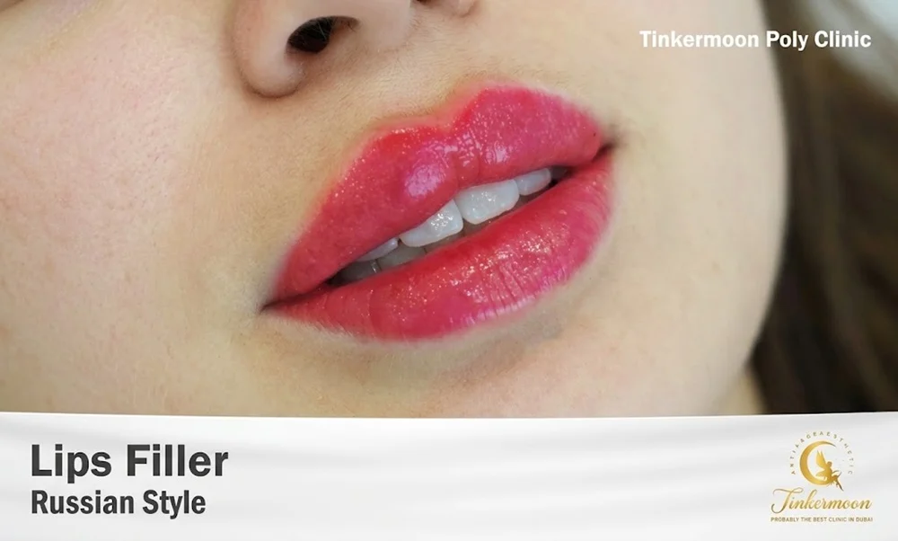 Typical ranges include:

Lip fillers: around 6–12 months

Cheek fillers: around 9–18 months

Jawline and chin fillers: around 12–18 months

Under-eye fillers: around 9–12 months