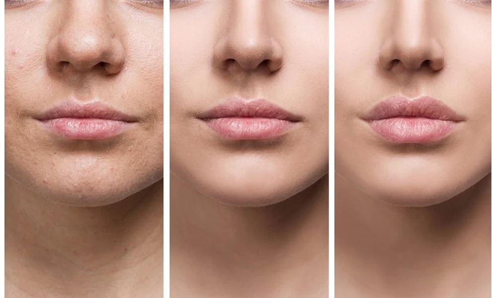 Several factors can influence how long dermal fillers last, including the filler itself, the treatment area, and individual characteristics.