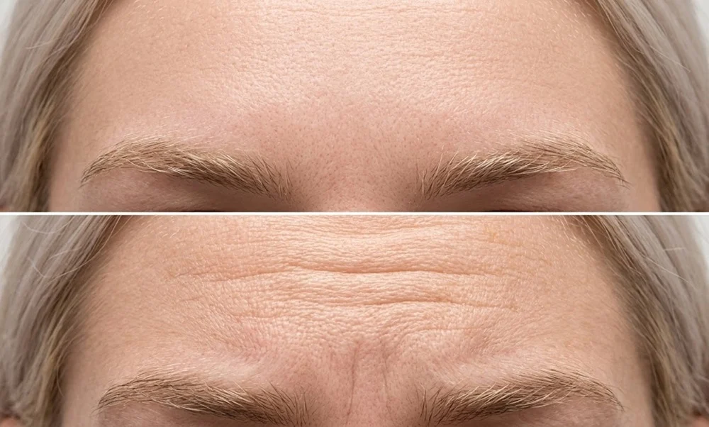 the First Few Hours after Botox