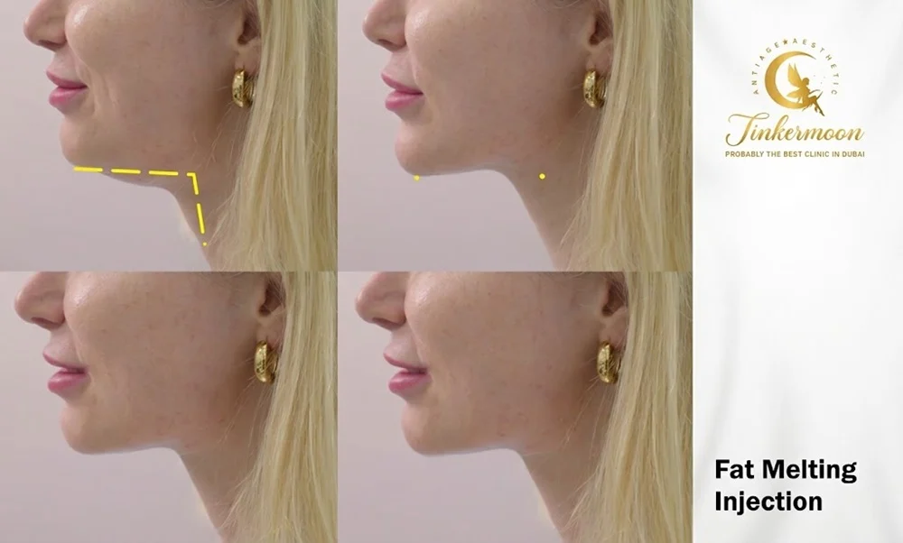 Dermal Fillers Timeline