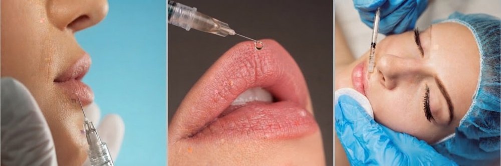 Comparing Lip Filler Types and Their Lifespans