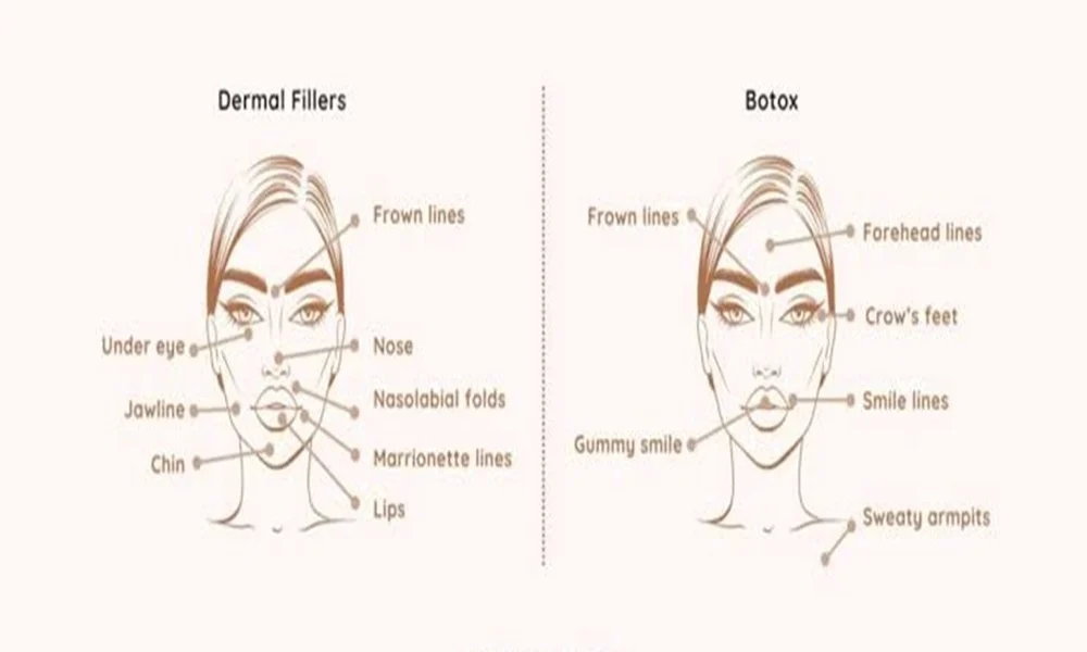Dermal fillers and Botox work in different ways