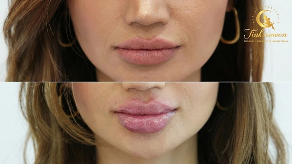 Are Dermal Fillers Safe