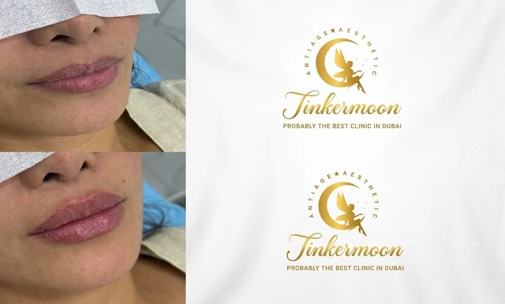  dermal fillers are generally safe