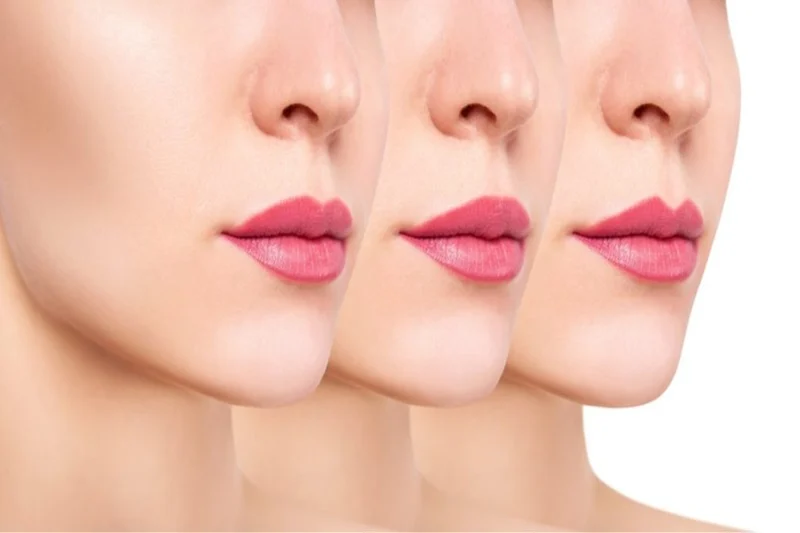 Dermal fillers, most commonly based on hyaluronic acid
