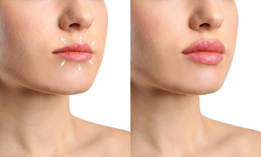 longevity of HA fillers varies depending on the specific product