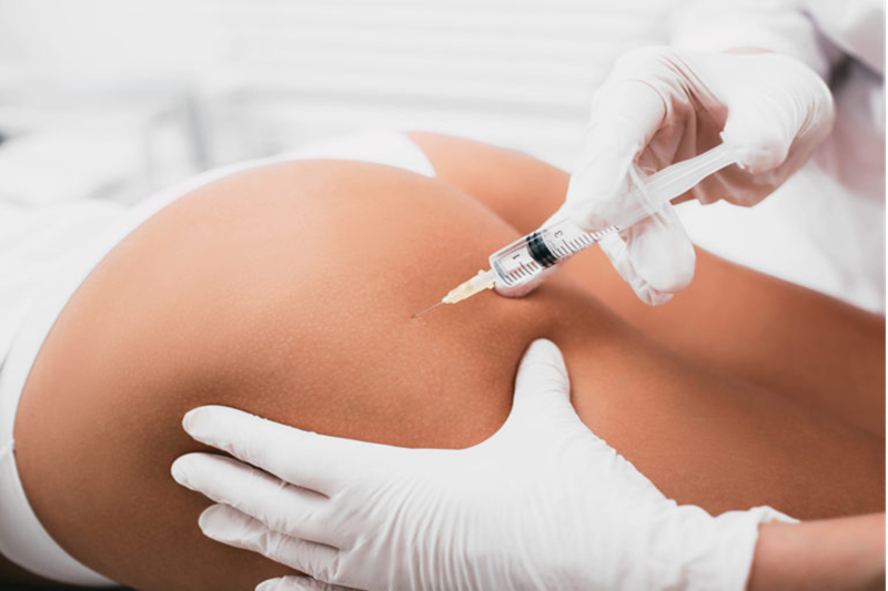 Different Buttock Shapes and the Ideal Filler for Each