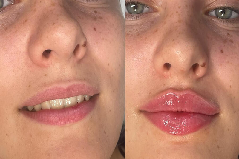 Myth 4: Lip Fillers Are Permanent