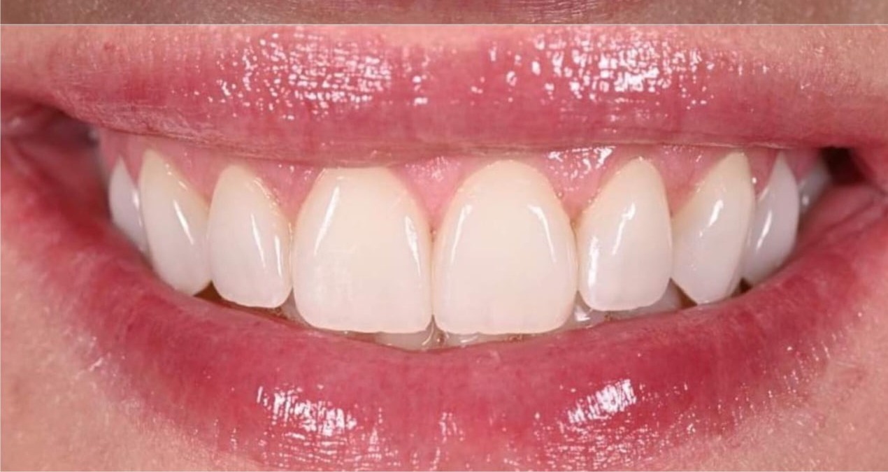 After Hollywood Smile