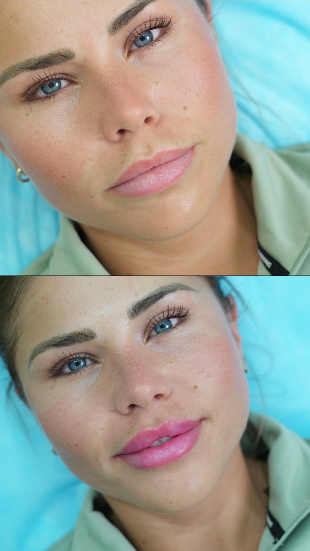 Dermal Fillers Cost in Dubai: