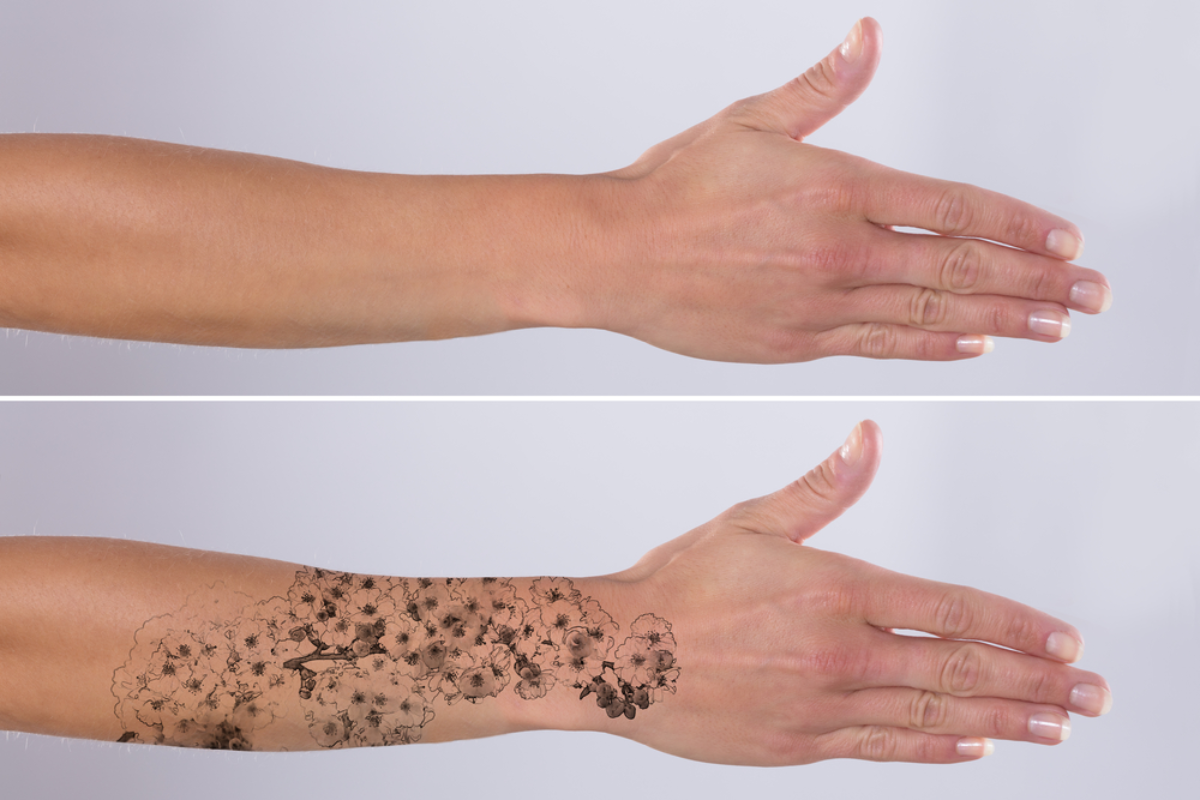 Does Laser Tattoo Removal Leave Scars?