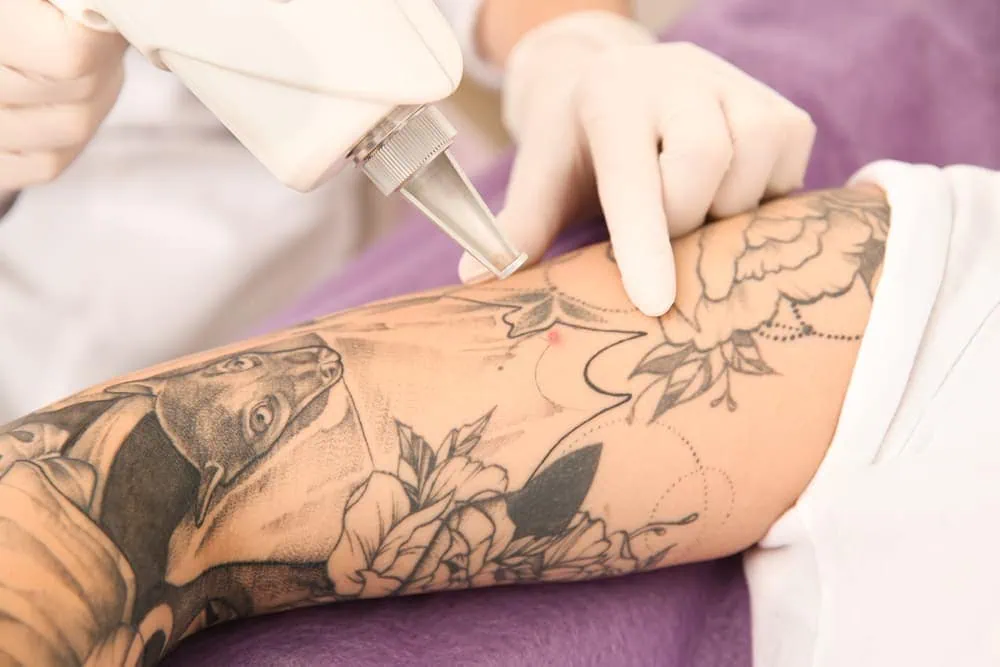How Should I Prepare for My Tattoo Removal Appointment?