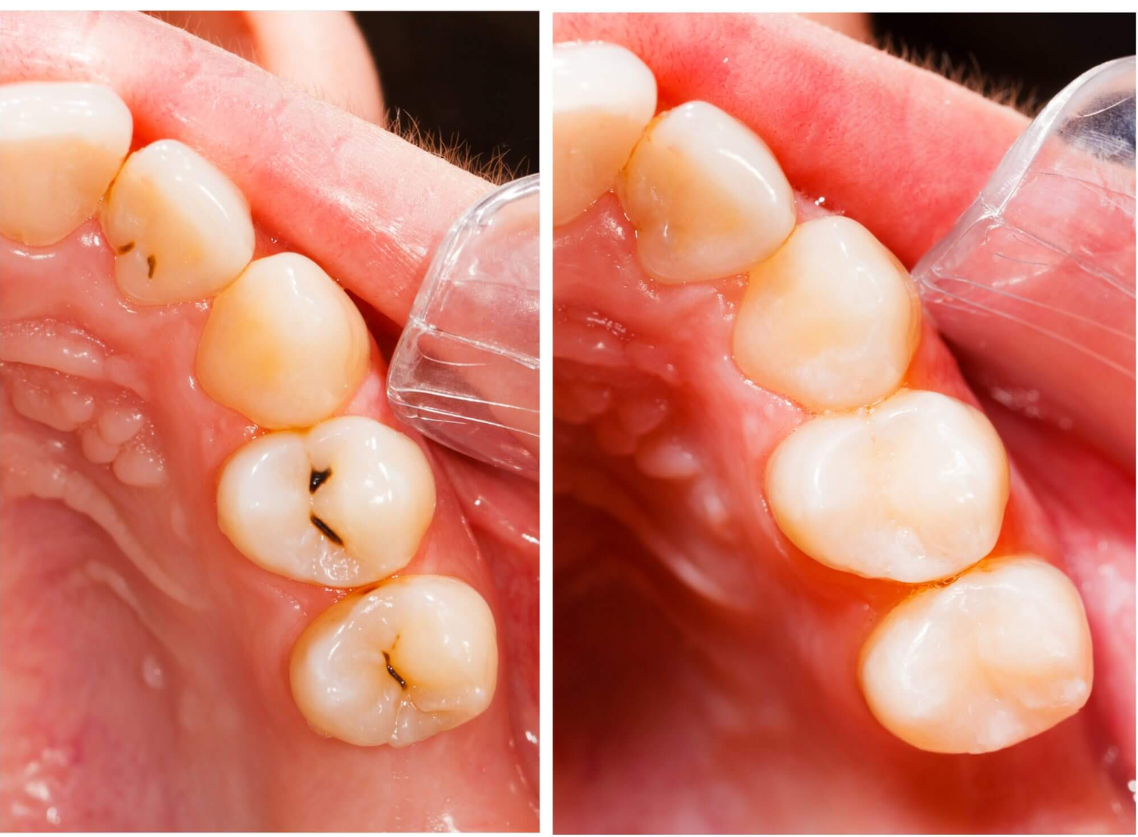 Teeth Filling Cost in Dubai