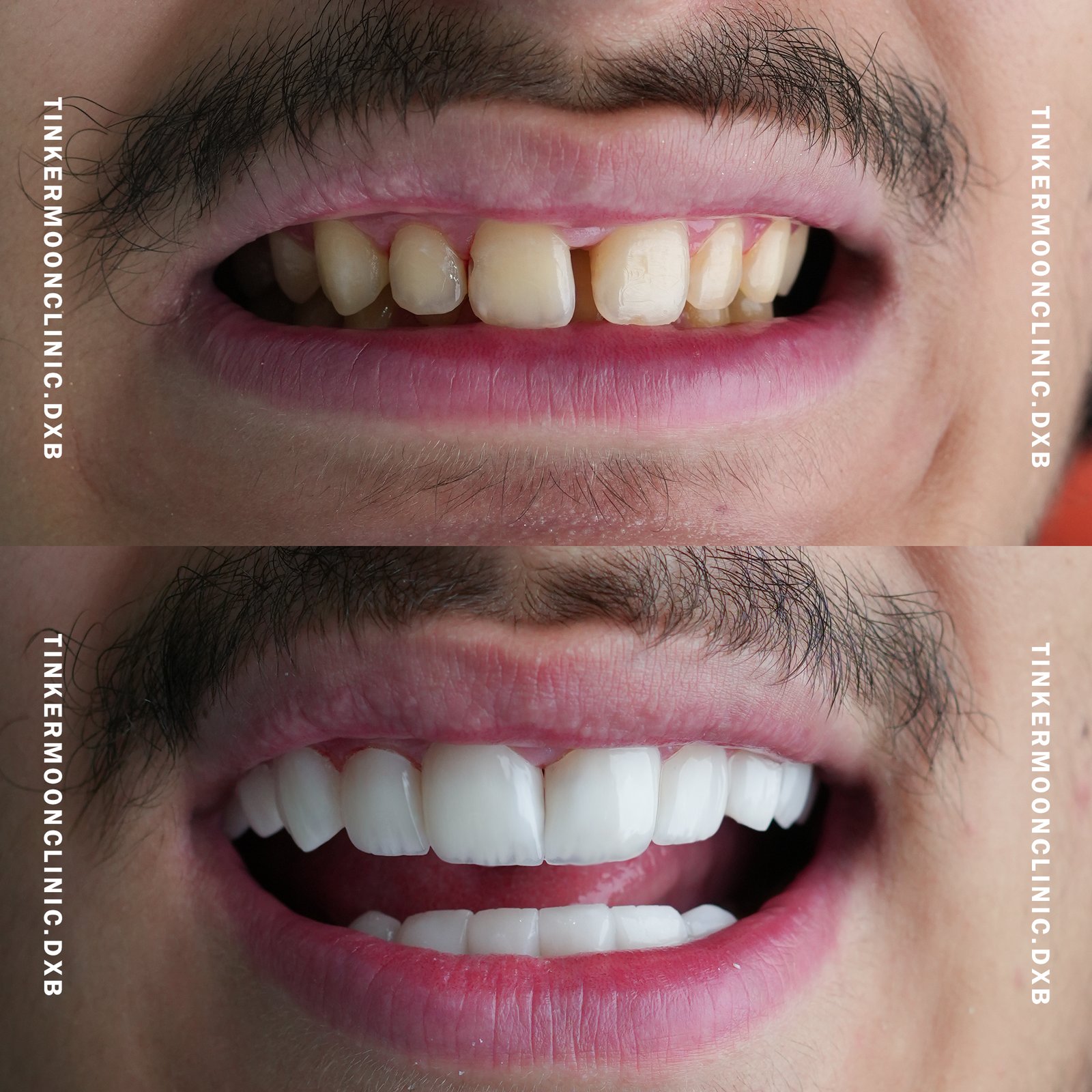 Benefits of Dental Cleaning