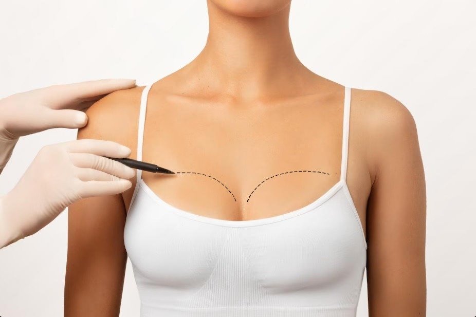 Breast Fillers ideal candidate