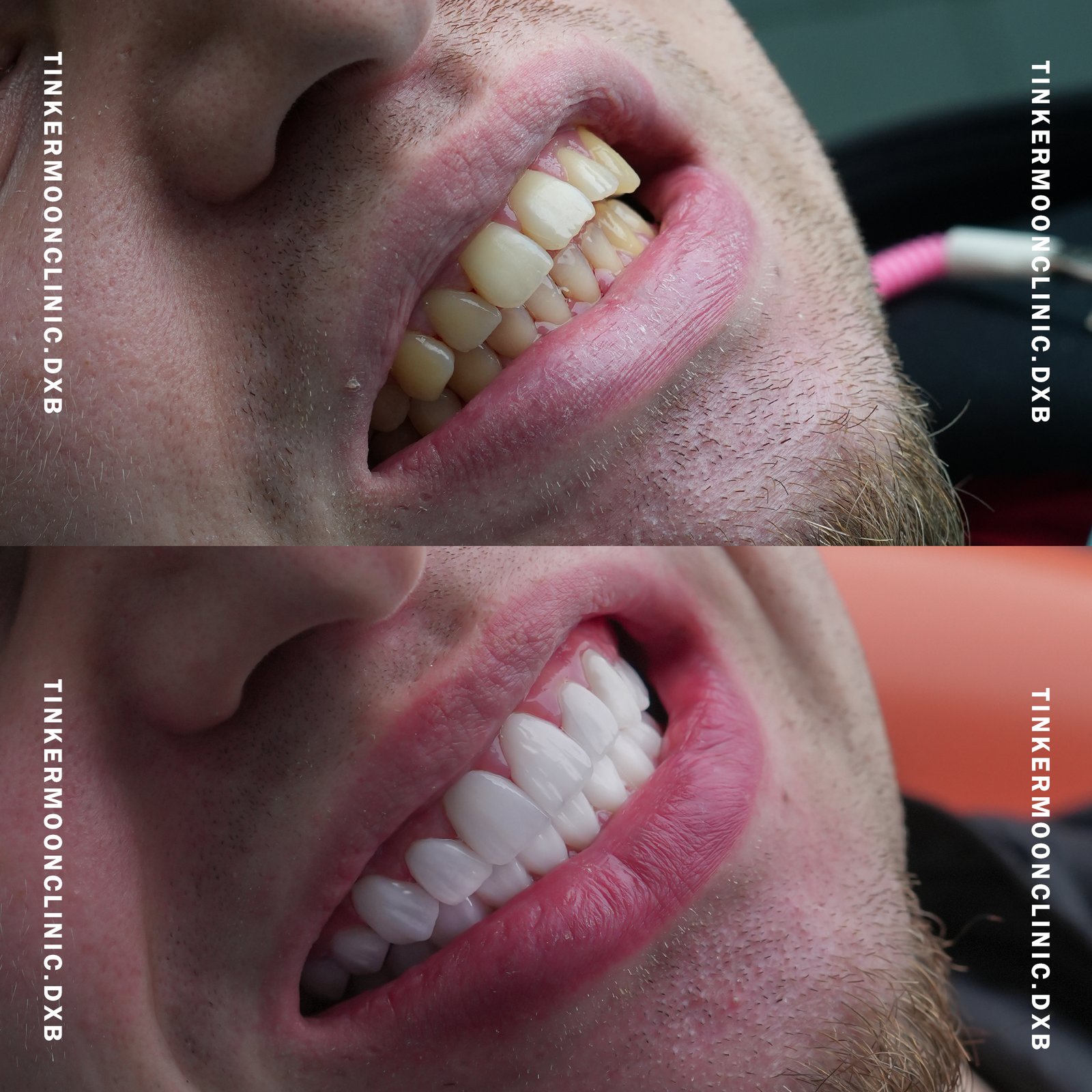 Dental Cleaning Cost in Dubai