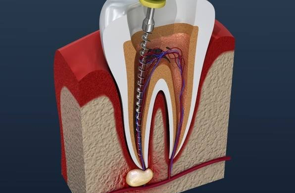 Dental Implants Cost in Dubai