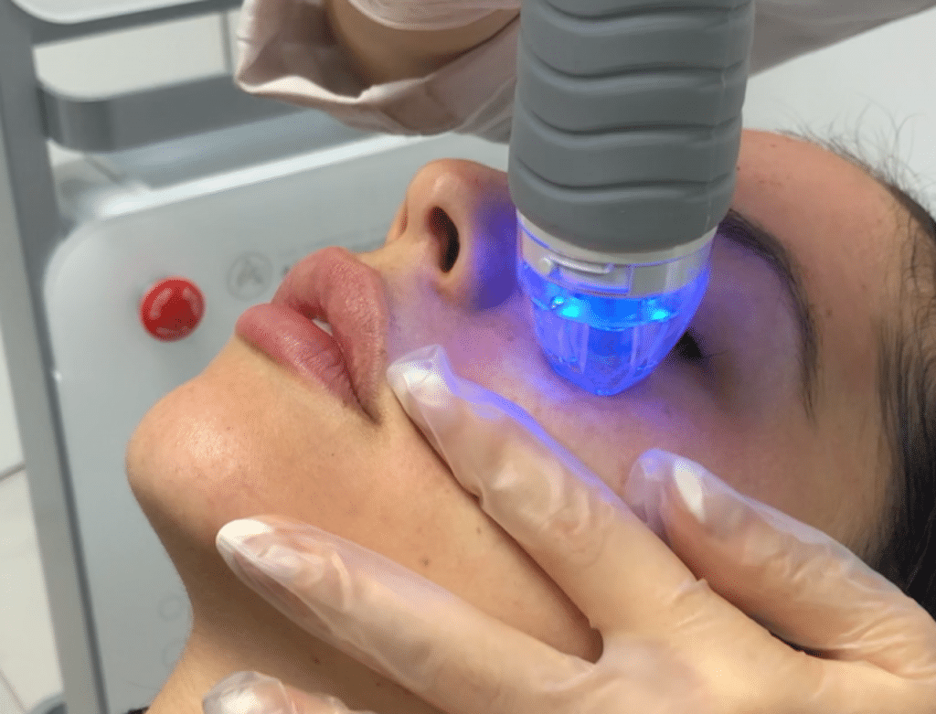 تكلفة Microneedling RF في دبي