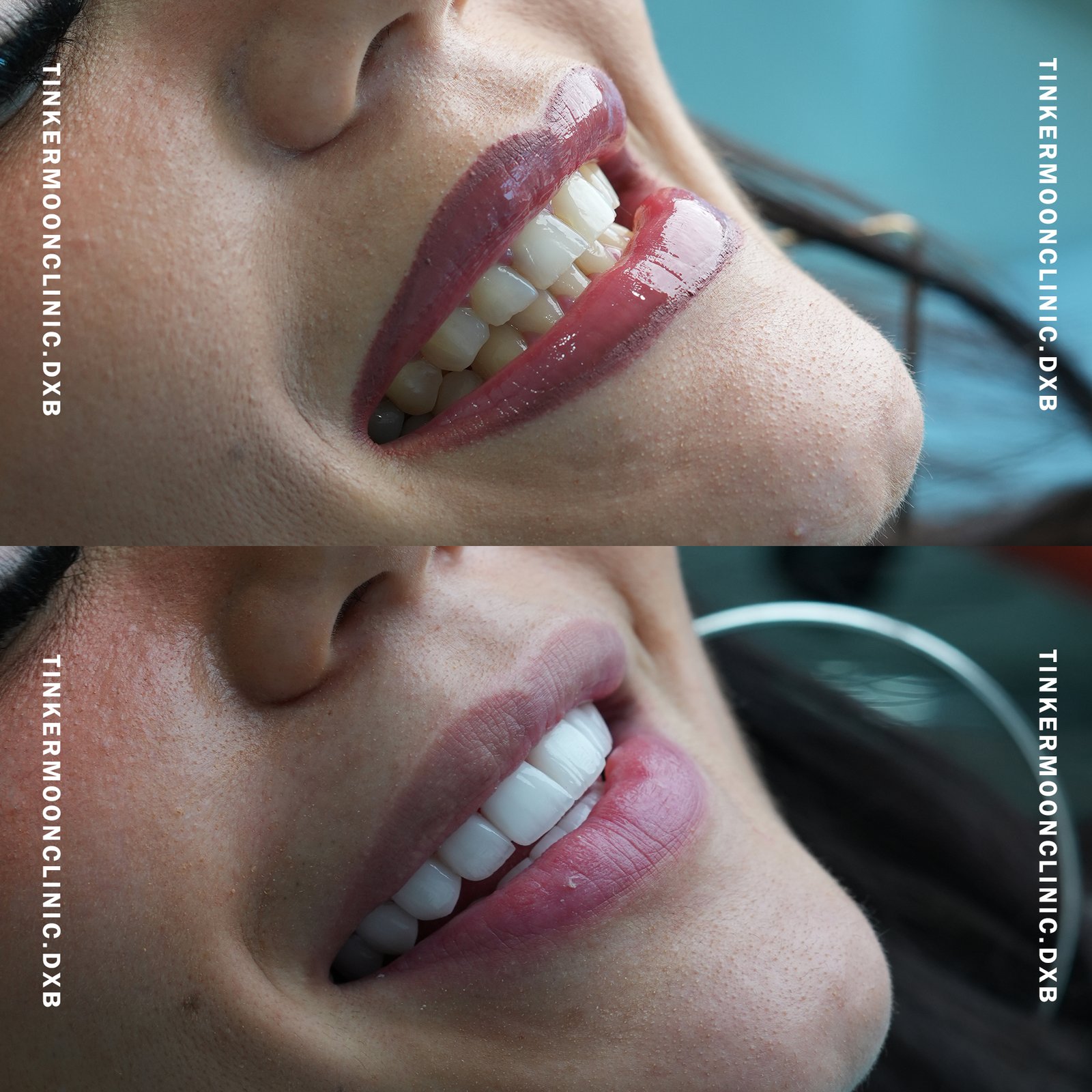 Dental Cleaning Before and After