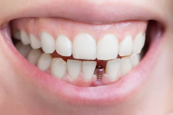 How Long Do Dental Implants Last?