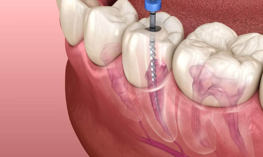 Are Dental Implants Safe?