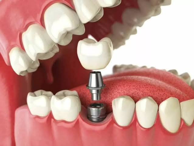 Dental Implants Cost in Dubai